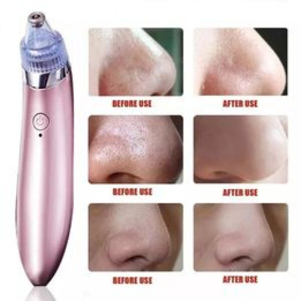 Xn 8030 Electric Blackhead Acne Oil Remover Vacuum 1 - Powerful Pimple